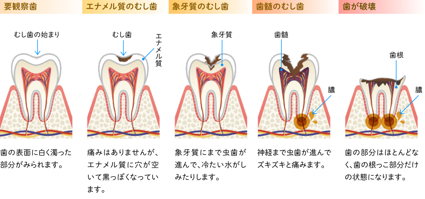 むし歯の進行図